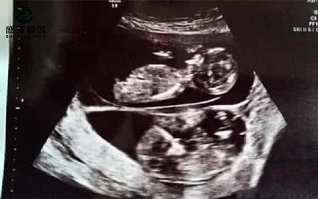 廣東男子做親子鑒定，竟發(fā)現(xiàn)自家雙胞胎有一個不是自己的？！